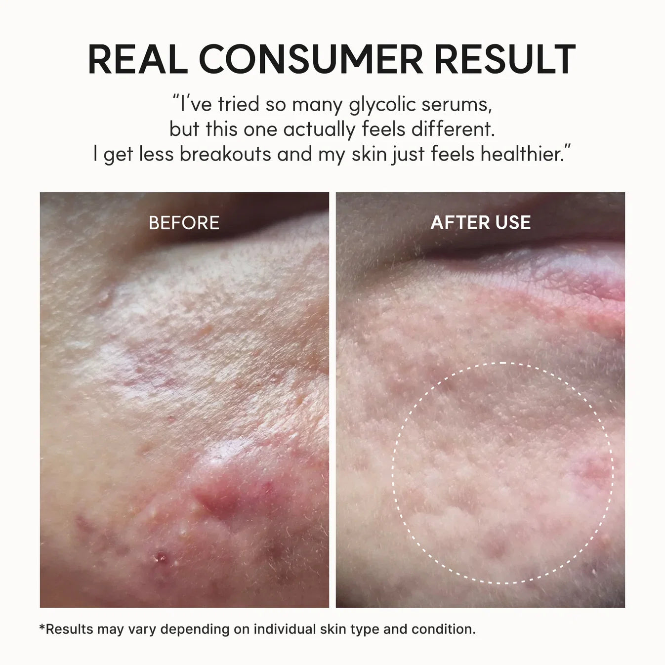 Lioraroot Clear Skin Duo – Glycolic Acid & Vitamin C Skincare Set