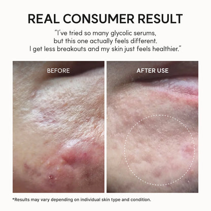 Lioraroot Clear Skin Duo – Glycolic Acid & Vitamin C Skincare Set
